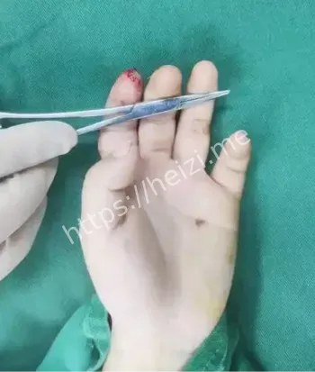 男孩断指