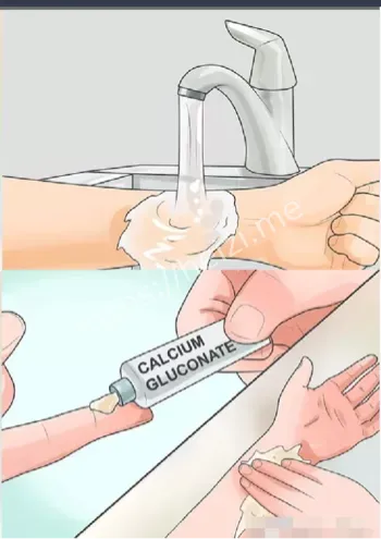 氢氟酸中毒