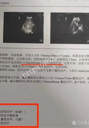 22厘米肌瘤现场细节